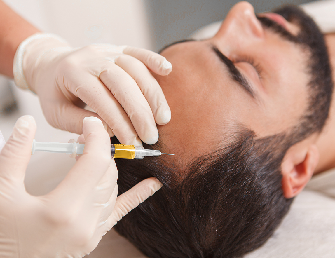Mans scalp being injected with PRP in areas that are receding and balding